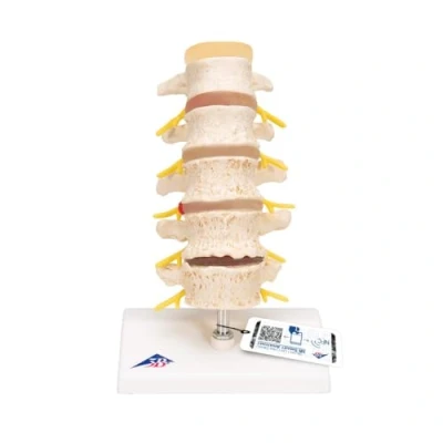 Abbildung von 3B Scientific Menschliche Anatomie Stadien des Bandscheibenvorfalls und der Wirbeldegeneration + kostenlose App Smart Anatomy, A795