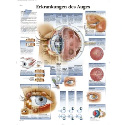 Abbildung von 3B Scientific Lehtrafel Erkrankungen des Auges, VR0231UU